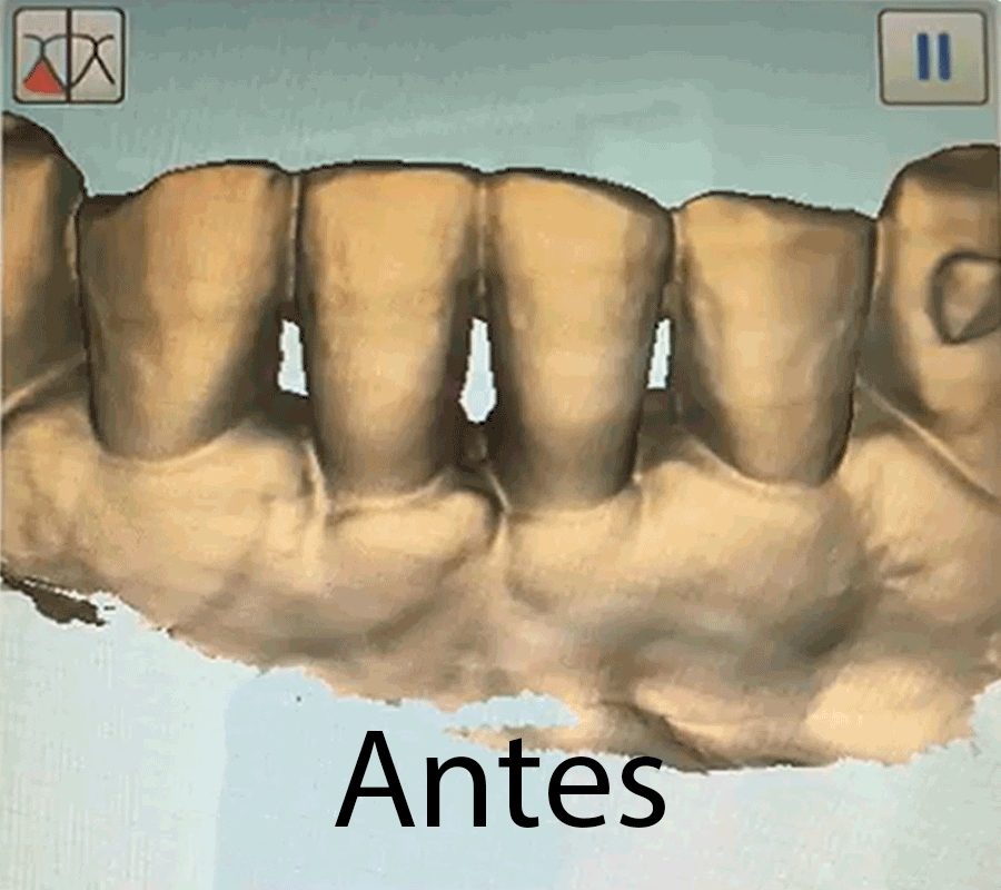Escaneamento dos dentes, antes e depois das restaurações.